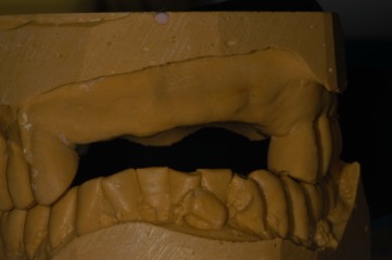 Denture